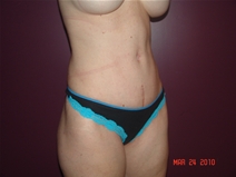 Tummy Tuck After Photo by Moneer Jaibaji, MD; Coronado, CA - Case 22327