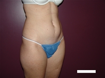 Tummy Tuck Before Photo by Moneer Jaibaji, MD; Coronado, CA - Case 22327