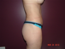 Tummy Tuck After Photo by Moneer Jaibaji, MD; Coronado, CA - Case 22327