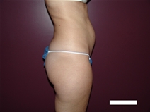 Tummy Tuck Before Photo by Moneer Jaibaji, MD; Coronado, CA - Case 22327