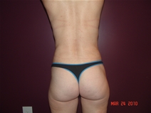 Liposuction After Photo by Moneer Jaibaji, MD; Coronado, CA - Case 22328