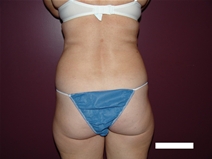 Liposuction Before Photo by Moneer Jaibaji, MD; Coronado, CA - Case 22328