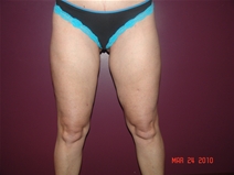 Liposuction After Photo by Moneer Jaibaji, MD; Coronado, CA - Case 22328