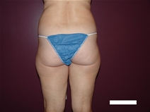 Liposuction Before Photo by Moneer Jaibaji, MD; Coronado, CA - Case 22328