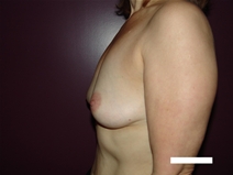 Breast Augmentation Before Photo by Moneer Jaibaji, MD; Coronado, CA - Case 22365