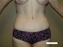 Tummy Tuck After Photo by Moneer Jaibaji, MD; Coronado, CA - Case 22378