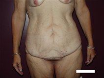 Tummy Tuck Before Photo by Moneer Jaibaji, MD; Coronado, CA - Case 22378