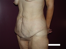 Tummy Tuck Before Photo by Moneer Jaibaji, MD; Coronado, CA - Case 22378