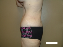 Tummy Tuck After Photo by Moneer Jaibaji, MD; Coronado, CA - Case 22378