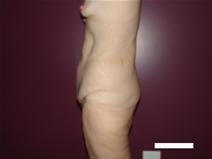 Tummy Tuck Before Photo by Moneer Jaibaji, MD; Coronado, CA - Case 22378