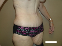 Tummy Tuck After Photo by Moneer Jaibaji, MD; Coronado, CA - Case 22378