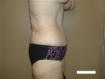 Tummy Tuck After Photo by Moneer Jaibaji, MD; Coronado, CA - Case 22378