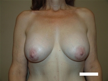 Breast Augmentation After Photo by Moneer Jaibaji, MD; Coronado, CA - Case 22379