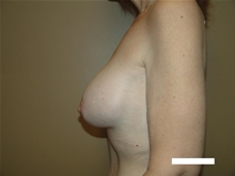Breast Augmentation After Photo by Moneer Jaibaji, MD; Coronado, CA - Case 22379