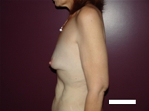 Breast Augmentation Before Photo by Moneer Jaibaji, MD; Coronado, CA - Case 22379