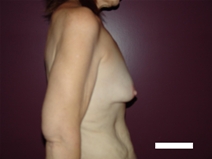 Breast Augmentation Before Photo by Moneer Jaibaji, MD; Coronado, CA - Case 22379