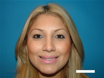 Rhinoplasty After Photo by Moneer Jaibaji, MD; Coronado, CA - Case 22493