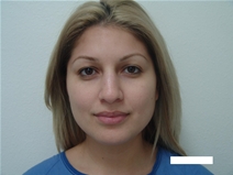 Rhinoplasty Before Photo by Moneer Jaibaji, MD; Coronado, CA - Case 22493