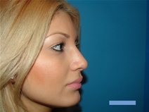 Rhinoplasty After Photo by Moneer Jaibaji, MD; Coronado, CA - Case 22493