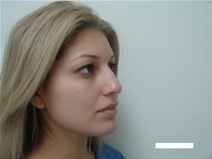 Rhinoplasty Before Photo by Moneer Jaibaji, MD; Coronado, CA - Case 22493