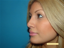 Rhinoplasty After Photo by Moneer Jaibaji, MD; Coronado, CA - Case 22493