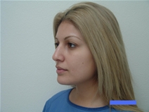 Rhinoplasty Before Photo by Moneer Jaibaji, MD; Coronado, CA - Case 22493