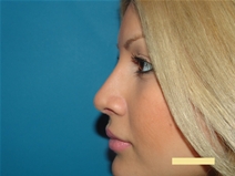 Rhinoplasty After Photo by Moneer Jaibaji, MD; Coronado, CA - Case 22493