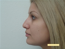 Rhinoplasty Before Photo by Moneer Jaibaji, MD; Coronado, CA - Case 22493