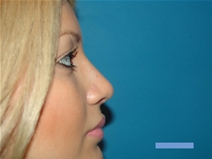 Rhinoplasty After Photo by Moneer Jaibaji, MD; Coronado, CA - Case 22493