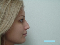 Rhinoplasty Before Photo by Moneer Jaibaji, MD; Coronado, CA - Case 22493