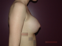 Breast Augmentation After Photo by Moneer Jaibaji, MD; Coronado, CA - Case 22551