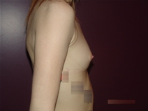 Breast Augmentation Before Photo by Moneer Jaibaji, MD; Coronado, CA - Case 22551