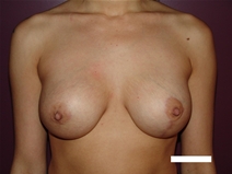 Breast Lift After Photo by Moneer Jaibaji, MD; Coronado, CA - Case 22552
