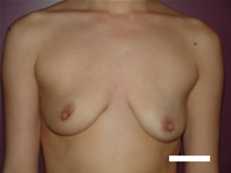 Breast Lift Before Photo by Moneer Jaibaji, MD; Coronado, CA - Case 22552