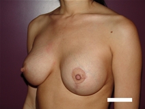 Breast Lift After Photo by Moneer Jaibaji, MD; Coronado, CA - Case 22552