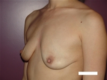 Breast Lift Before Photo by Moneer Jaibaji, MD; Coronado, CA - Case 22552
