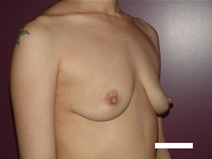 Breast Lift Before Photo by Moneer Jaibaji, MD; Coronado, CA - Case 22552