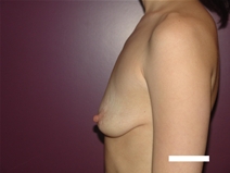 Breast Lift Before Photo by Moneer Jaibaji, MD; Coronado, CA - Case 22552