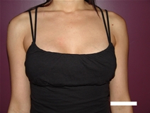Breast Lift Before Photo by Moneer Jaibaji, MD; Coronado, CA - Case 22552