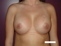 Breast Augmentation After Photo by Moneer Jaibaji, MD; Coronado, CA - Case 22572