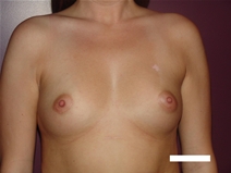 Breast Augmentation Before Photo by Moneer Jaibaji, MD; Coronado, CA - Case 22572