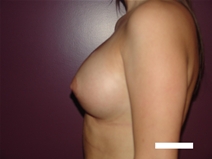 Breast Augmentation After Photo by Moneer Jaibaji, MD; Coronado, CA - Case 22572