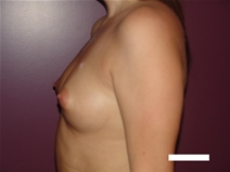 Breast Augmentation Before Photo by Moneer Jaibaji, MD; Coronado, CA - Case 22572