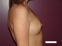 Breast Augmentation Before Photo by Moneer Jaibaji, MD; Coronado, CA - Case 22572