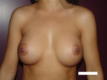 Breast Augmentation After Photo by Moneer Jaibaji, MD; Coronado, CA - Case 22594