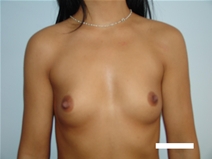 Breast Augmentation Before Photo by Moneer Jaibaji, MD; Coronado, CA - Case 22594