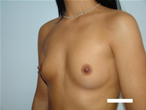 Breast Augmentation Before Photo by Moneer Jaibaji, MD; Coronado, CA - Case 22594