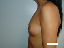 Breast Augmentation Before Photo by Moneer Jaibaji, MD; Coronado, CA - Case 22594