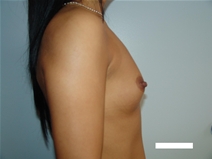 Breast Augmentation Before Photo by Moneer Jaibaji, MD; Coronado, CA - Case 22594
