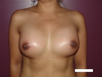 Breast Augmentation After Photo by Moneer Jaibaji, MD; Coronado, CA - Case 22635